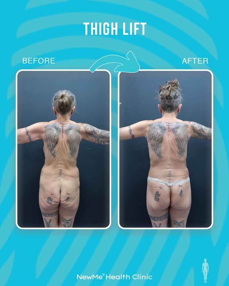 Thigh lift before and after — Dr. Bahadır, NewMe patient