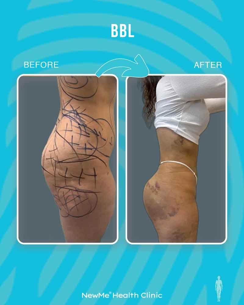 Brazilian butt lift before and after — Dr. Bahadır, NewMe patient