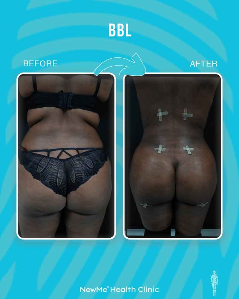 Brazilian butt lift before and after — Dr. Houtan, NewMe patient
