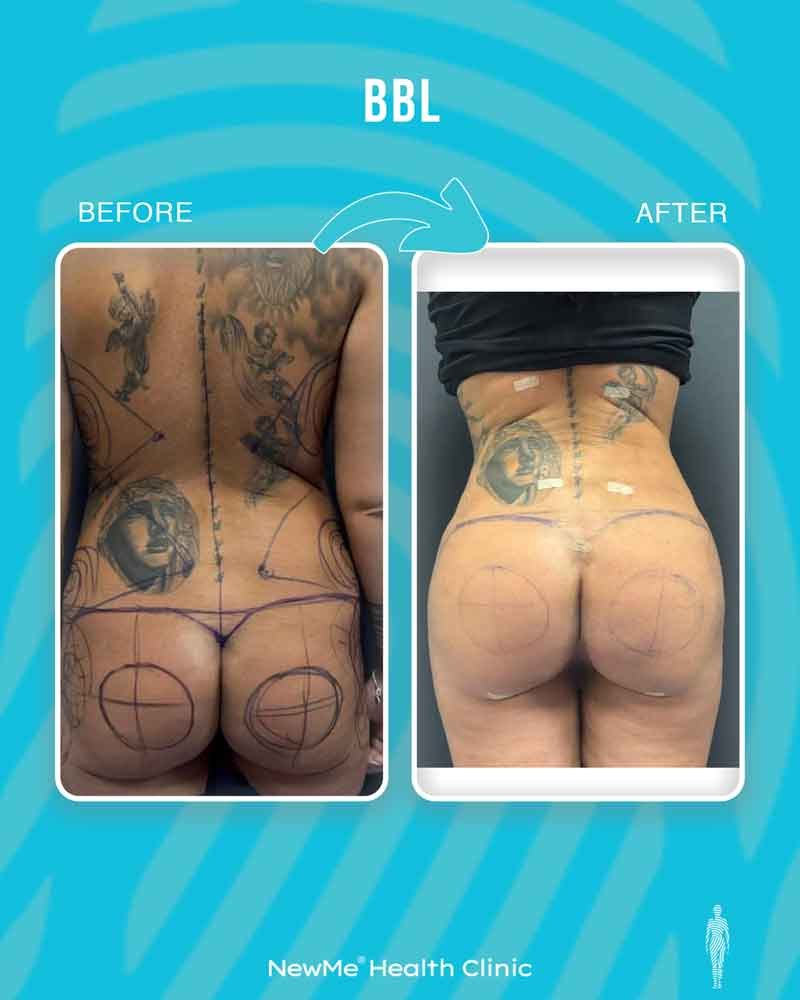 Brazilian butt lift before and after — Dr. Bahadır, NewMe patient