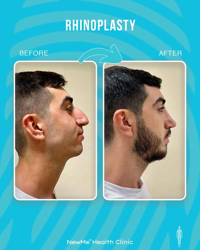 Rhinoplasty before and after — Dr. Bahadır, NewMe patient
