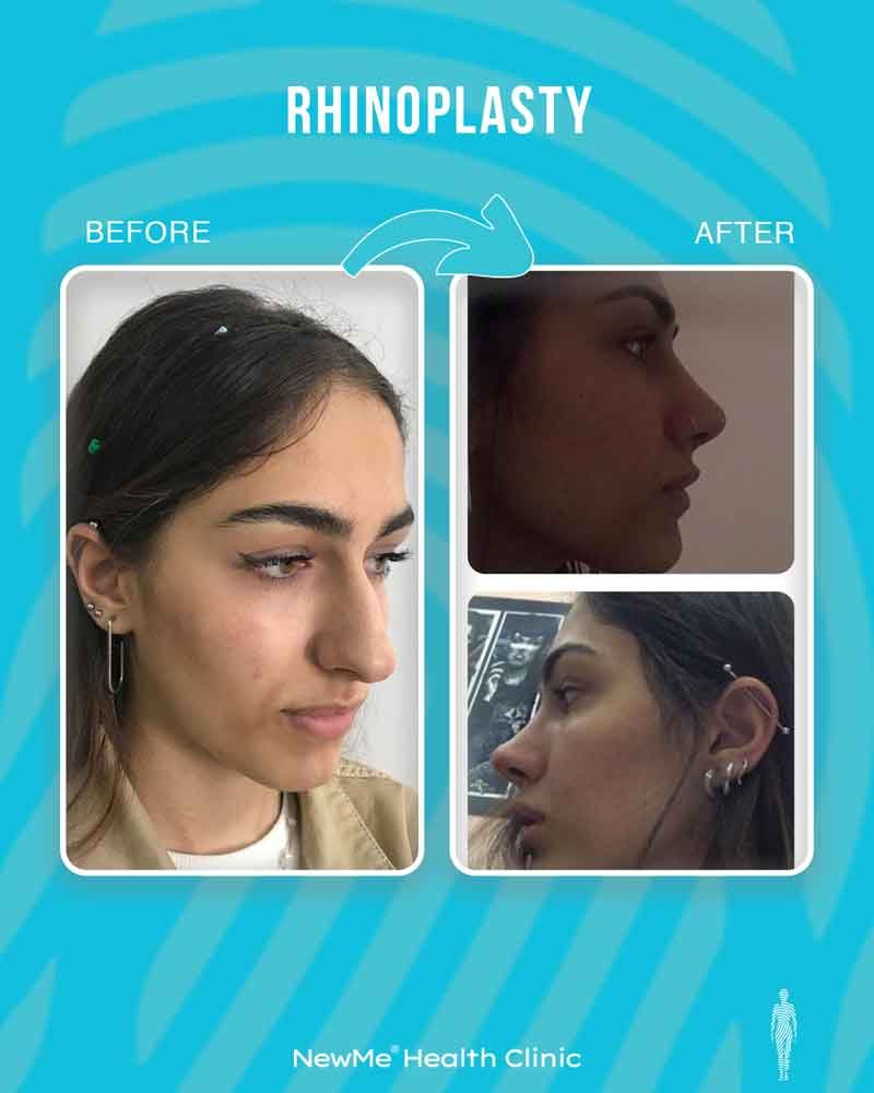 Rhinoplasty before and after — Dr. Bahadır, NewMe patient