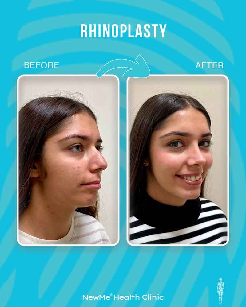 Rhinoplasty before and after — Dr. Bahadır, NewMe patient