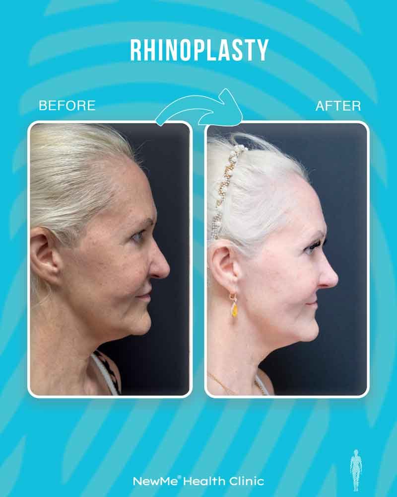 Rhinoplasty before and after — Dr. Bahadır, NewMe patient