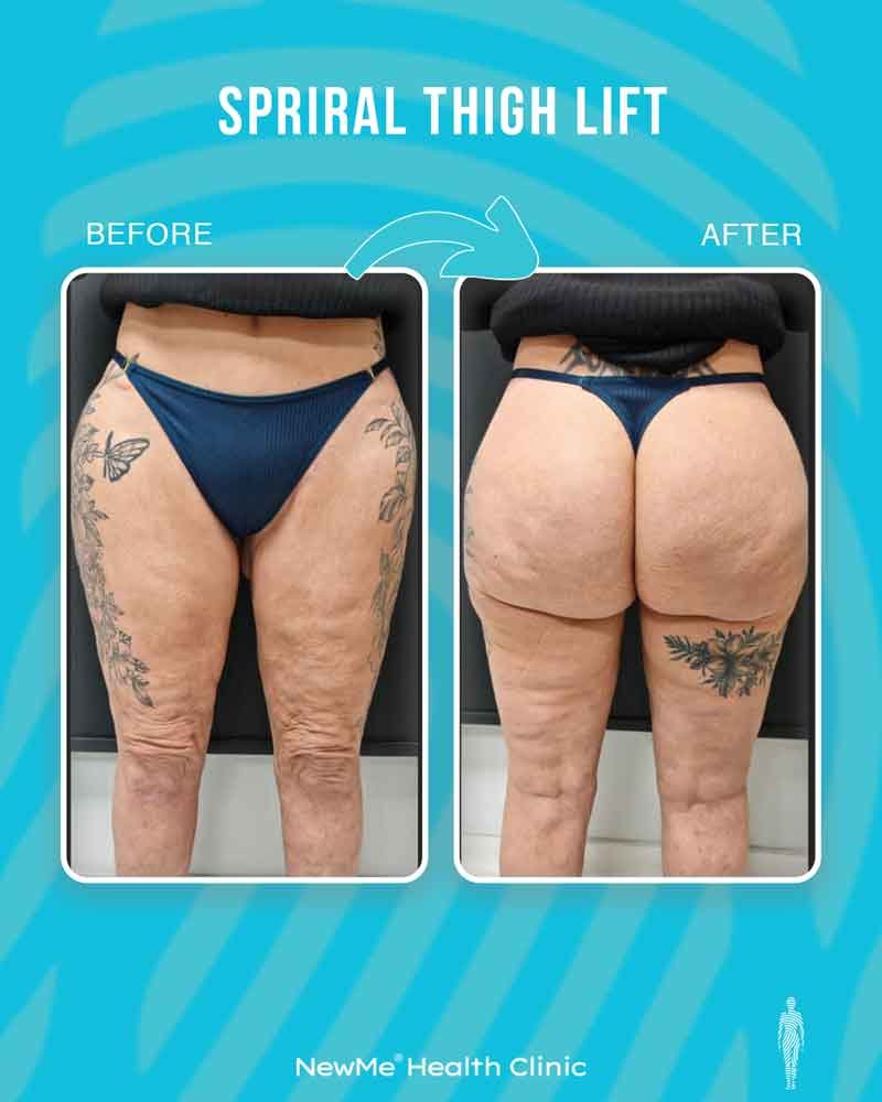 Thigh lift before and after — Dr. Houtan, NewMe patient