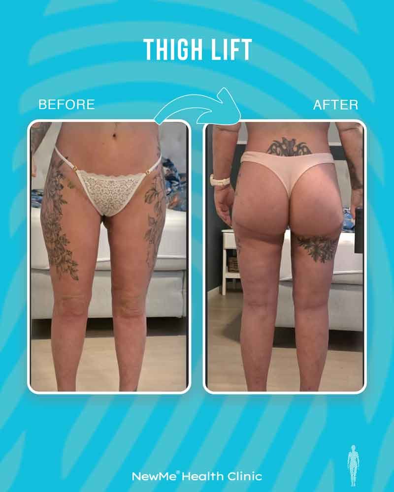 Thigh lift before and after — Dr. Houtan, NewMe patient