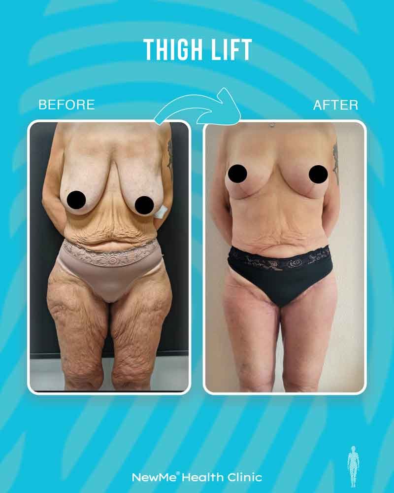 Thigh lift before and after — Dr. Houtan, NewMe patient
