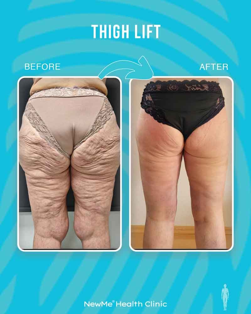Thigh lift before and after — Dr. Houtan, NewMe patient
