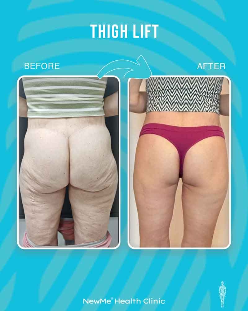 Thigh lift before and after — Dr. Houtan, NewMe patient