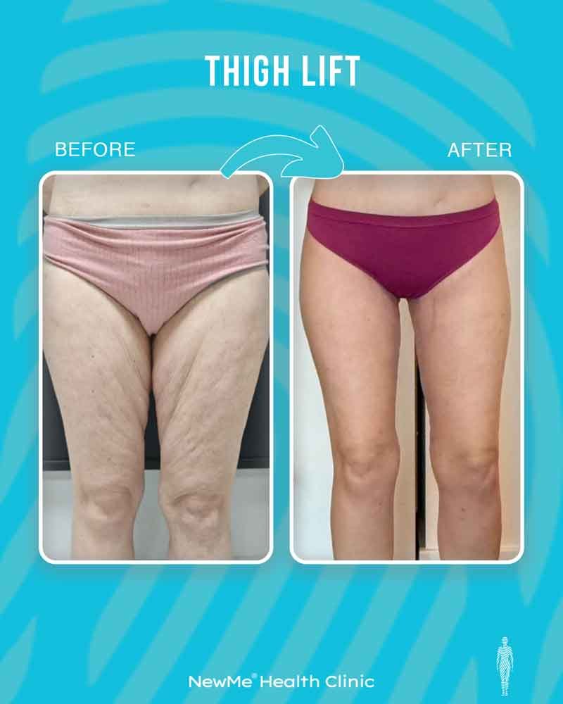 Thigh lift before and after — Dr. Houtan, NewMe patient