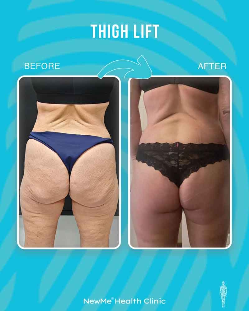 Thigh lift before and after — Dr. Houtan, NewMe patient